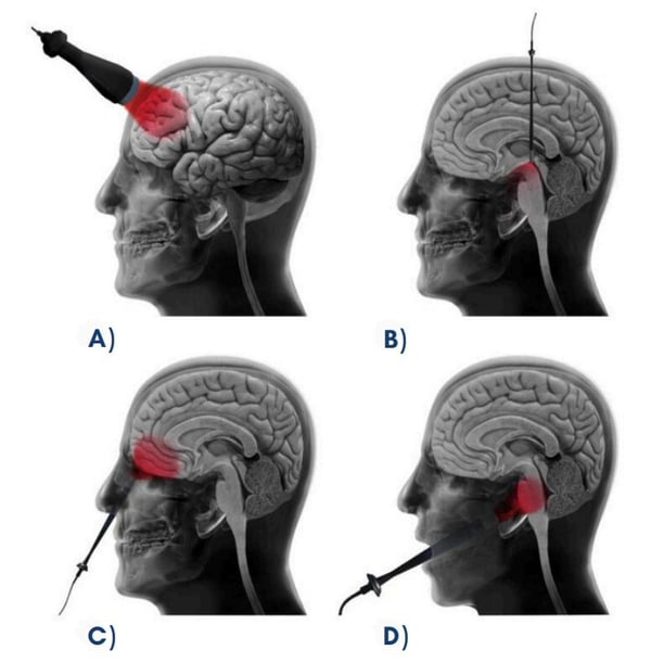brain-photobiomodulation-therapy-2