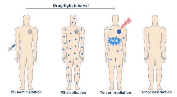photodynamic-therapy-review