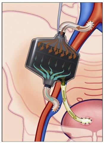 portable-artificial-kidney-systems