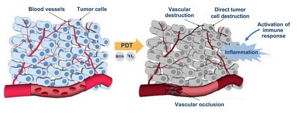 vascular-occlusion