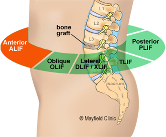 anterior access