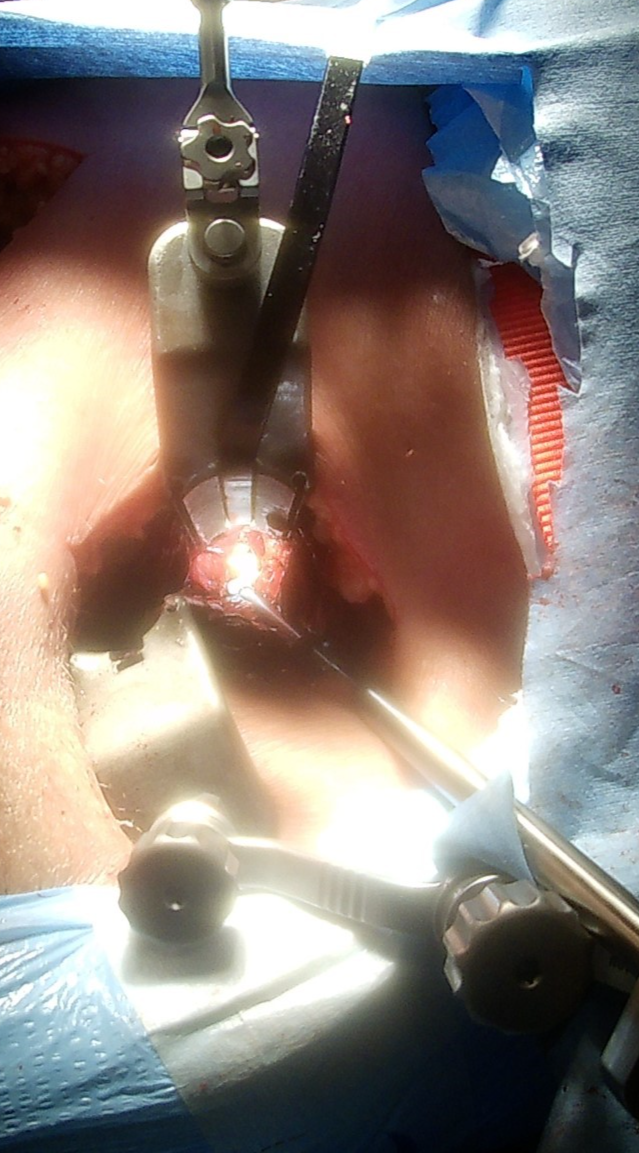 lighted surgical retractor in use 2